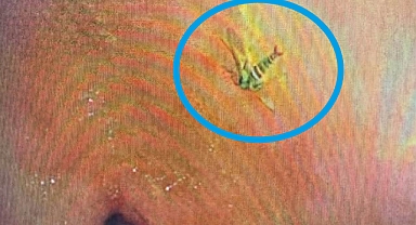 Sıra dışı vaka ‘midede arı’ 